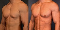 Male Chest Surgery