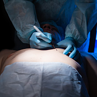 Gynecomastia Procedure